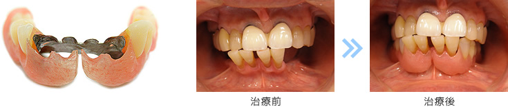 入れ歯症例 1 治療前後比較写真