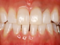 オフィスホワイトニング