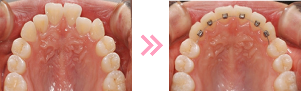 目立たない矯正2