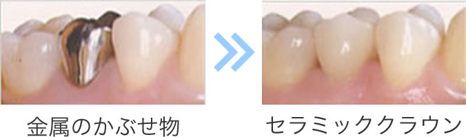 金属のかぶせ物