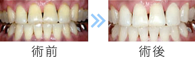 ホワイトニング施術前